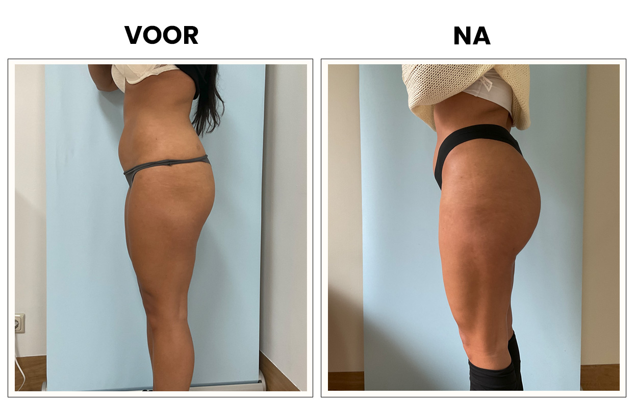 Lipofilliing billen Lipofilliing billen